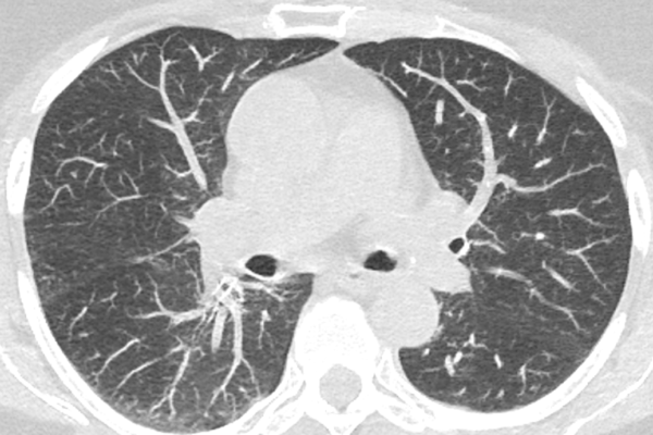 lung cancer screening